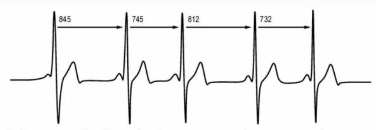 Вариабельность сердечного ритма. Вариабельность пульса ЭКГ. HR V вариабельность сердечного ритма. Низкая вариабельность сердечного ритма что это.